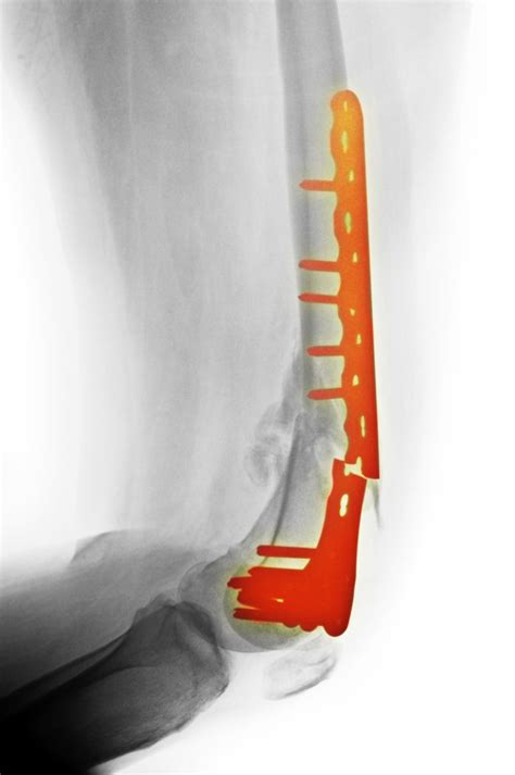 metal used to bracket bones|metal implants for broken bones.